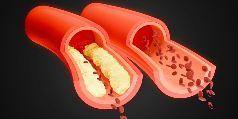 Charles V. Pollack, MD – Arterial Blood Clots and Treatment Options